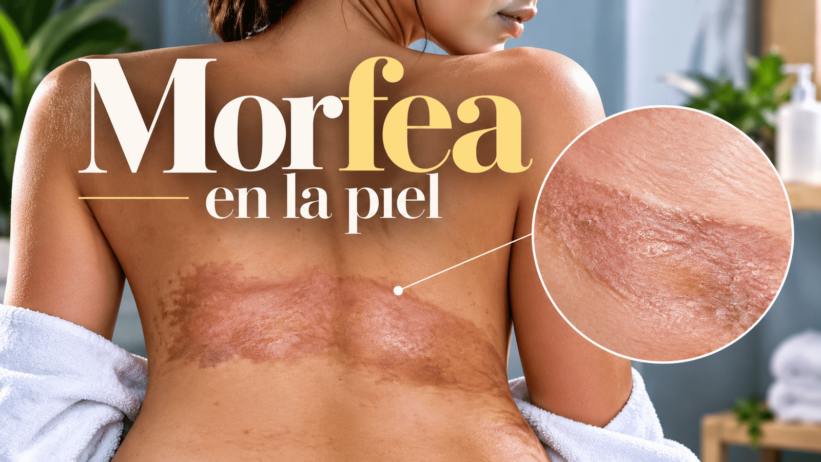 Morfea: cuando la piel produce demasiado colágeno