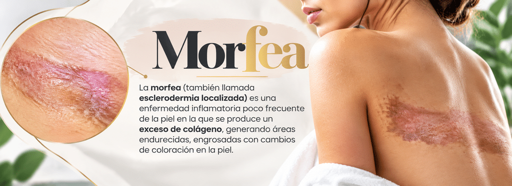 morfea